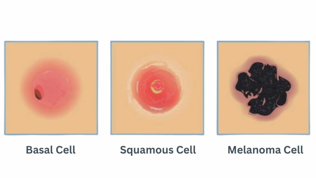 Basal Cell